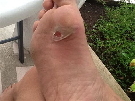 Foot Blister Treatment: How To Treat Blisters Properly - Blister Prevention