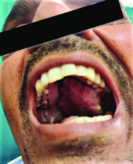 tumor   oral cavity  initial   scientific