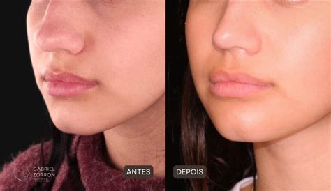 Como Afinar O Nariz De Batata Naturalmente - Rinoplastia para “nariz de batata”: tudo que você precisa saber ...