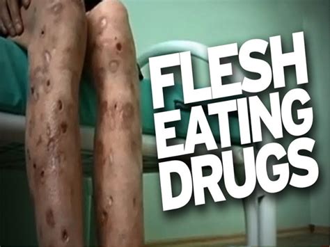 Krokodil: A deadly drug designed from Russia - Delhi Post