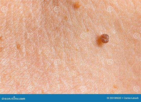 Papilloma Nevus Or Mole On Human Skin Stock Photo | CartoonDealer.com ...
