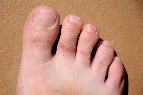 Foot Fungal Infection Blisters