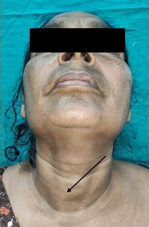 clinical photograph of right pulsatile anterior swelling | Download ...