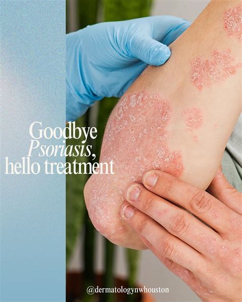 Say Goodbye to Psoriasis Symptoms with Otezla Treatment Now