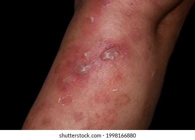 15,841 Boils skin Images, Stock Photos & Vectors | Shutterstock