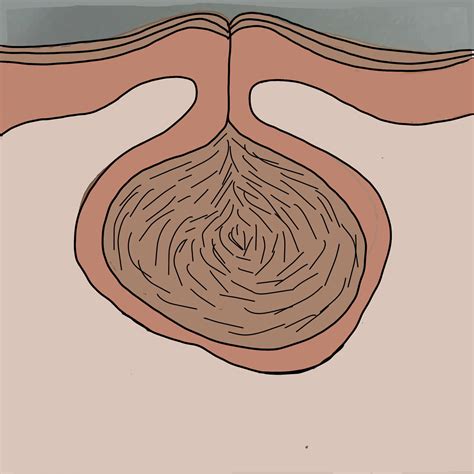 That epidermoid cyst earlobe might disappear on its own
