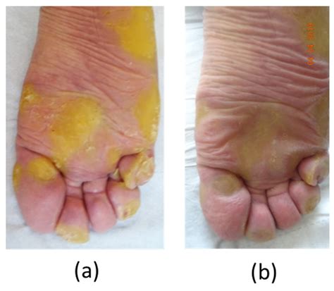 Keratoderma Debridement (corns, calluses, etc) - Doctor Steve