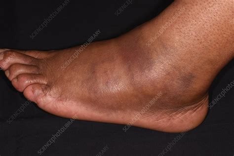 Fractured foot - Stock Image - C051/5742 - Science Photo Library