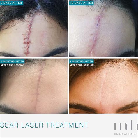 quick guide  laser scar removal   basics
