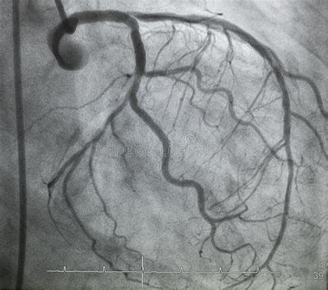 coronary angiography  ray image stock photo image  branch