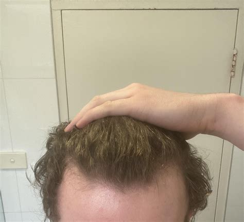 9 months Finasteride progress (1mg every day) : r/tressless