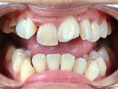 overcrowding teeth