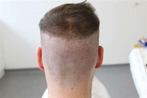 How Do I Take Care Of My Donor Area After Hair Transplant? - Cyber Hairsure