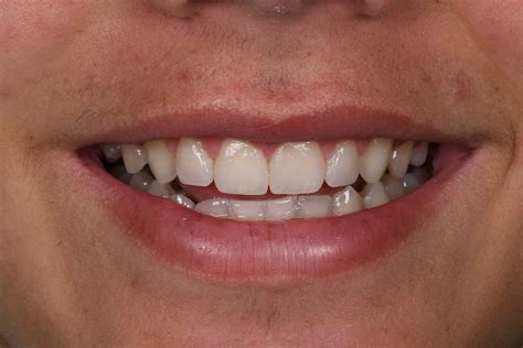 Reshaped Teeth & Fill Spaces with Composite - General & Cosmetic