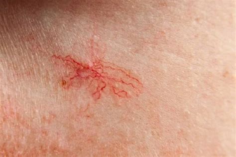 Metal allergy: symptoms, causes and treatment – Afrinik