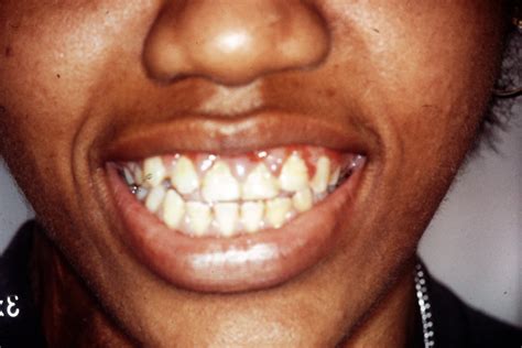 PICT0010 | Gingival hyperplasia | Dr. Ken Hashimoto | Wayne State ...