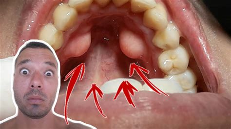 Buraquinho No Ceu Da Boca - Dente No Céu Da Boca , Céu da boca inflamado: o que pode ser (e o que ...