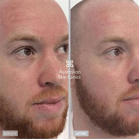 expert laser pigmentation removal  sydney vsmsp