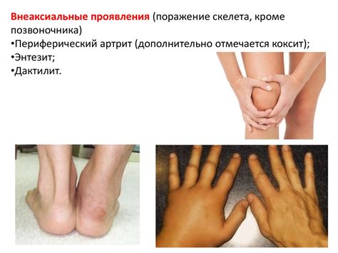 Серонегативные спондилоартриты. Дифференциальная диагностика ...
