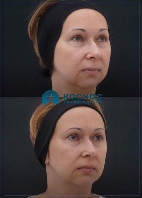 Full Face бьютификация лица за 1 процедуру - цена в Санкт-Петербурге