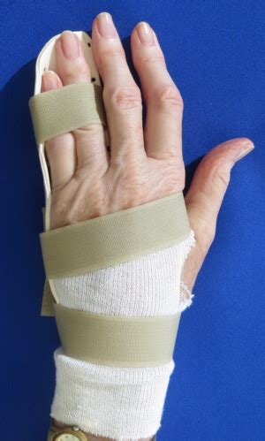 dupuytrens contracture splint  dupuytrens surgery dupuytrens