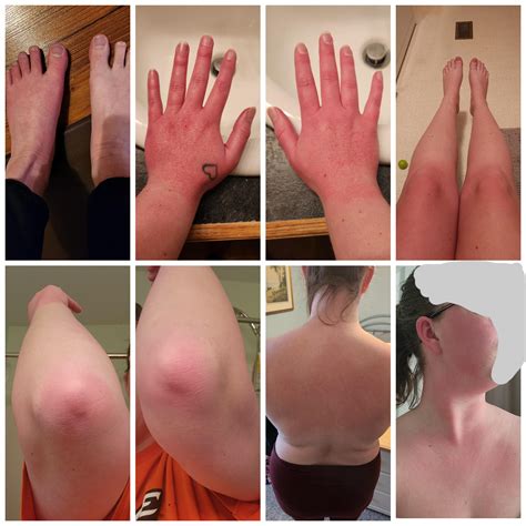 40 best r/erythromelalgia images on Pholder | anyone else’s camera roll