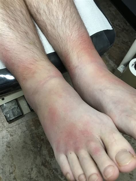 Tired And Achy Legs – Foot Culture