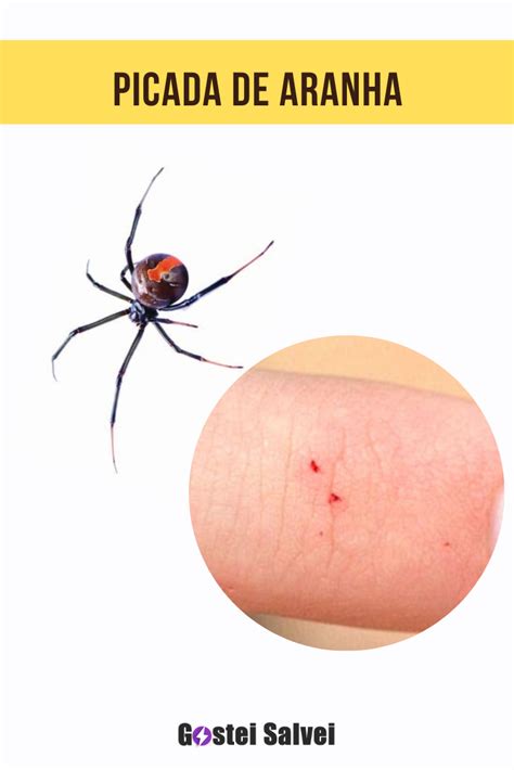 Como E Picada De Aranha - Como Tratar Picada De Aranha _ Picada de aranha – ZMFE