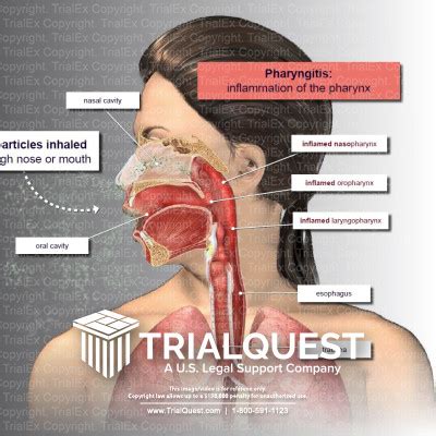 Pharyngitis - TrialExhibits Inc.