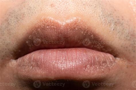 Grânulos De Fordyce Nos Labios - RETOEDU