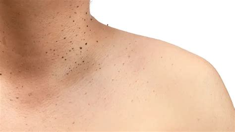 remove black spots    neck