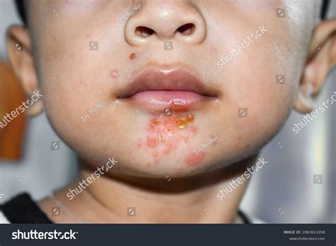 Staph Infection On Lips