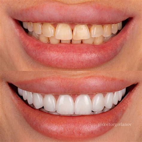 Пин от пользователя Nikki Johnstone на доске Teeth | Белые зубы ...