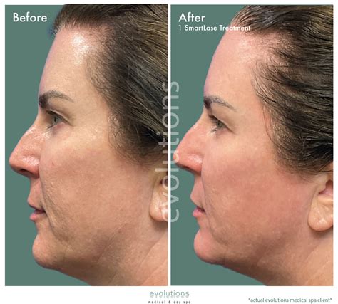 SmartLase CO2 Resurfacing in Santa Barbara | Evolutions Spa 805-849-4405