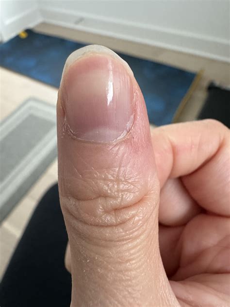 Periungual warts healing journey : r/Warts