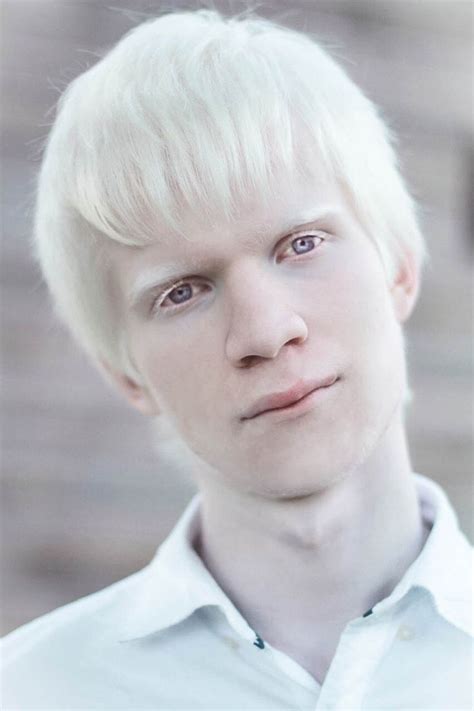 Albino Nedir? Albino Hastalığı Nedir? Nedenleri Nelerdir?-BİLGİLİ USTA