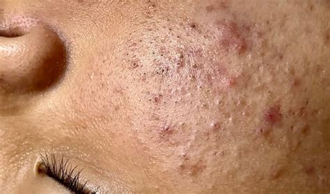 Blackhead Extractions Special "K" Another Great Video. Enilsa Brown ...