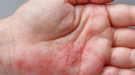 What is Tomato Flu? Causes, symptoms, prevention, and treatment ...