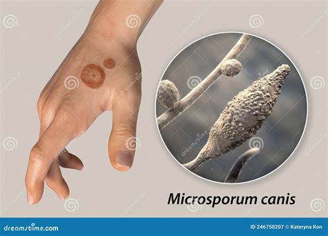 Fungal Infection on a Man S Hand. Tinea Manuum and Close-up View of ...