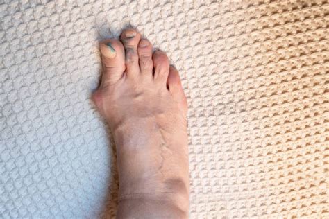 Curved Toenails Stock Photos, Pictures & Royalty-Free Images - iStock