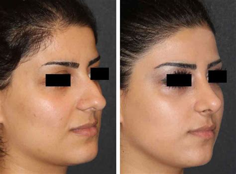 Rhinoplasty - Nose Job in Turkey | Cost, Reviews, Before After 2026