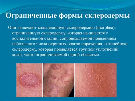 Склеродермия. Диагностика, лечение, профилактика склеродермии ...