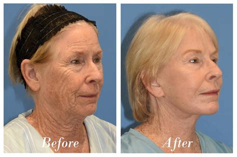 laser skin resurfacing    vip