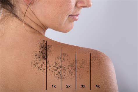 Benefits Of Laser Tattoo Removal. - Flex House - Home Improvement Ideas & Tips