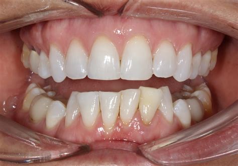 Before & Afters Crowding - Farrow & Dewbre Orthodontics