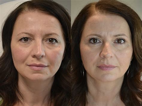 Upper Blepharoplasty Before and After Photos | Fresh Face + Eye