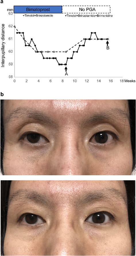 graph  fig  shows change  interpupillary