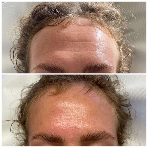 Botox For Men – With Before and After Images