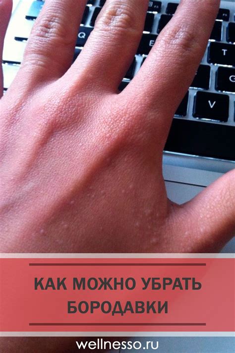 Как убрать бородавки: мази и гели | Лечение, Заболевания, Удаление ...