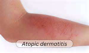 Amlitelimab Shows Promise in Moderate-to-Severe Atopic Dermatitis in